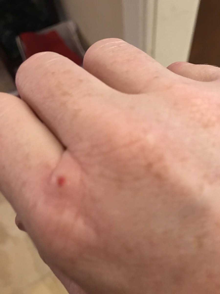 Diagnosed bed bug bite
