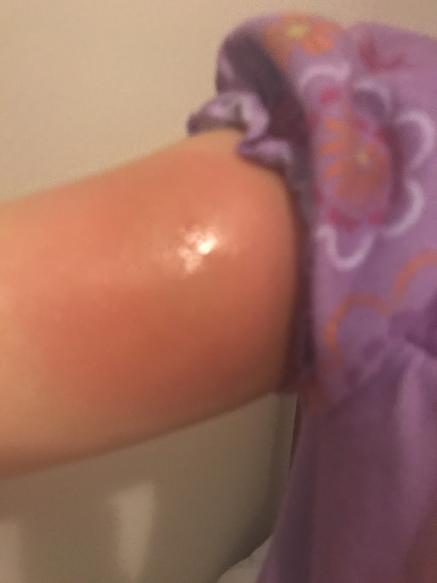 Bed bug bite later in the evening