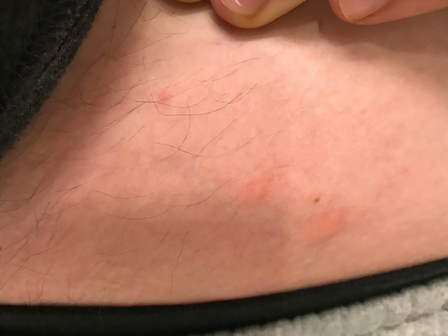 Bed bug Bites, the ol' 3 in a line
