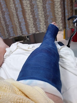 my broken leg in the hospital