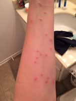 bed bug bites from Navigator of the Seas