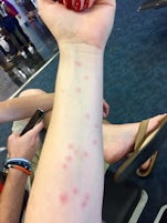 bed bug bites from Navigator of the Seas