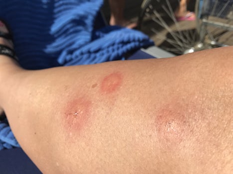 Sand flea bites from my cabin. Day 1 - got worse from then on.