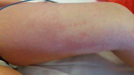 My daughters allergic reaction on the skin