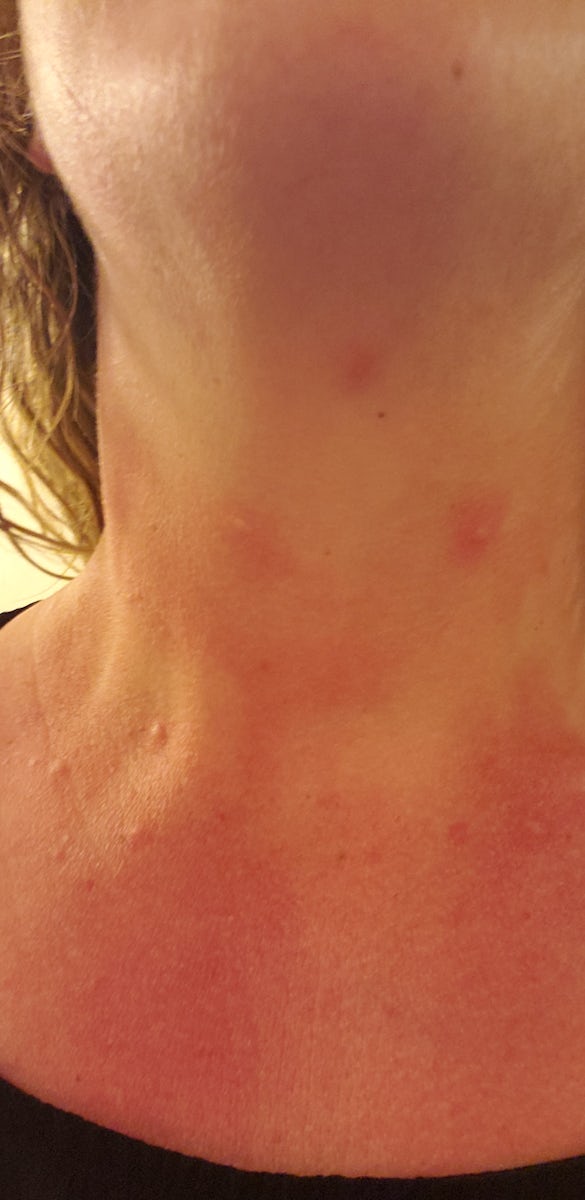 The bites on my neck :(