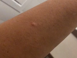 Bed bug bite