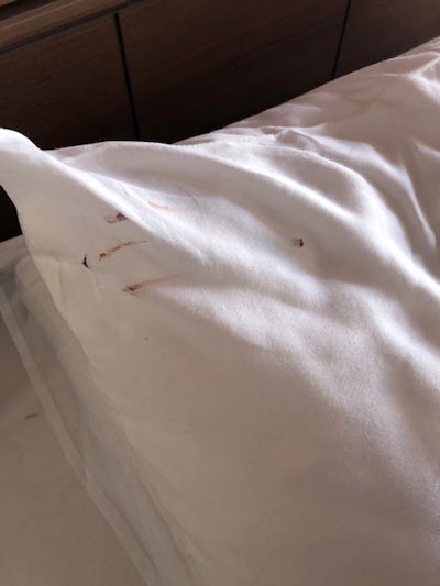 Dead bed bug with blood on pillowcase 
