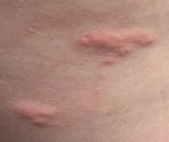 Bed bug bites on my back