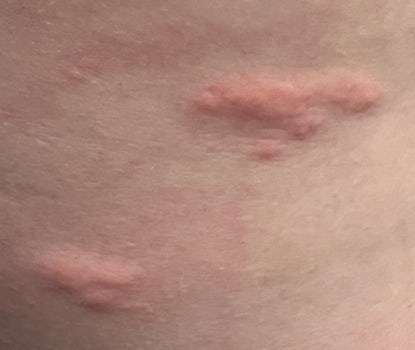 Bed bug bites on my back