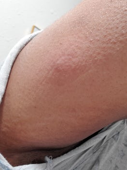 This is just one of the bedbugs bumps